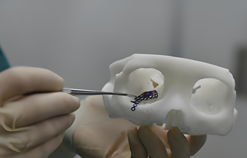Application of titanium mesh in orbital fracture surgery Application of titanium mesh in orbital fracture surgery